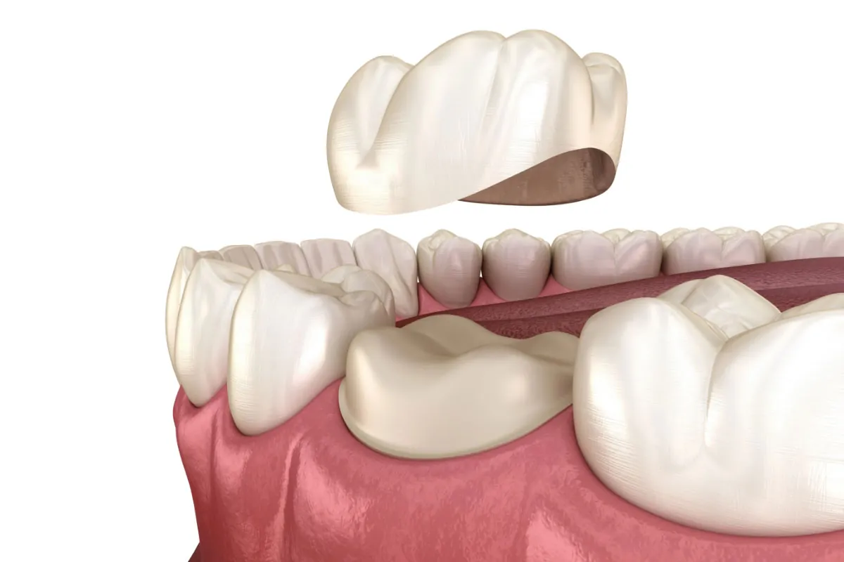 3D model showing how dental crowns can help restore your smile
